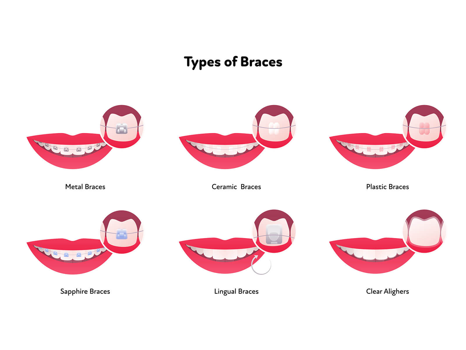 Understanding The Different Types of Braces