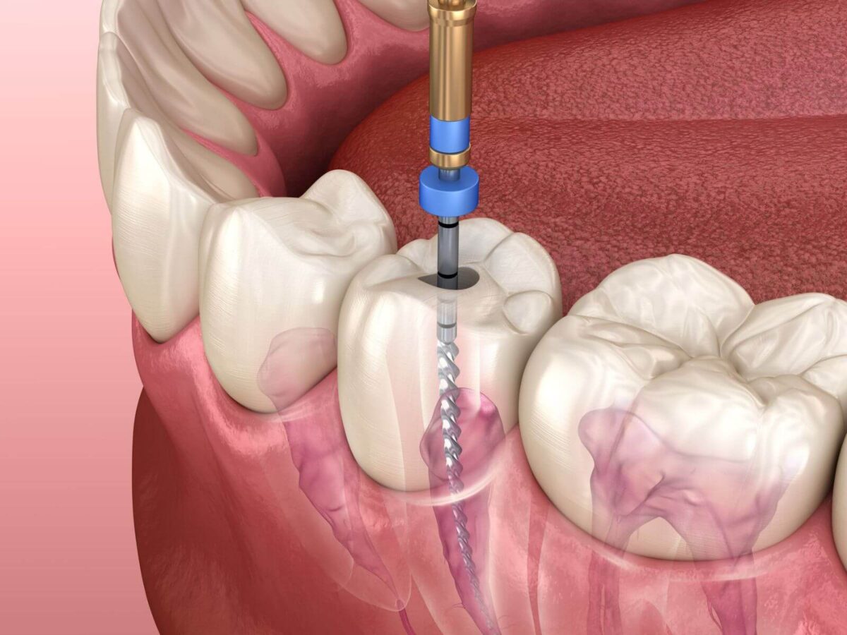 The Impact of Stress on Root Canal Treatment