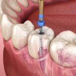 The Impact of Stress on Root Canal Treatment